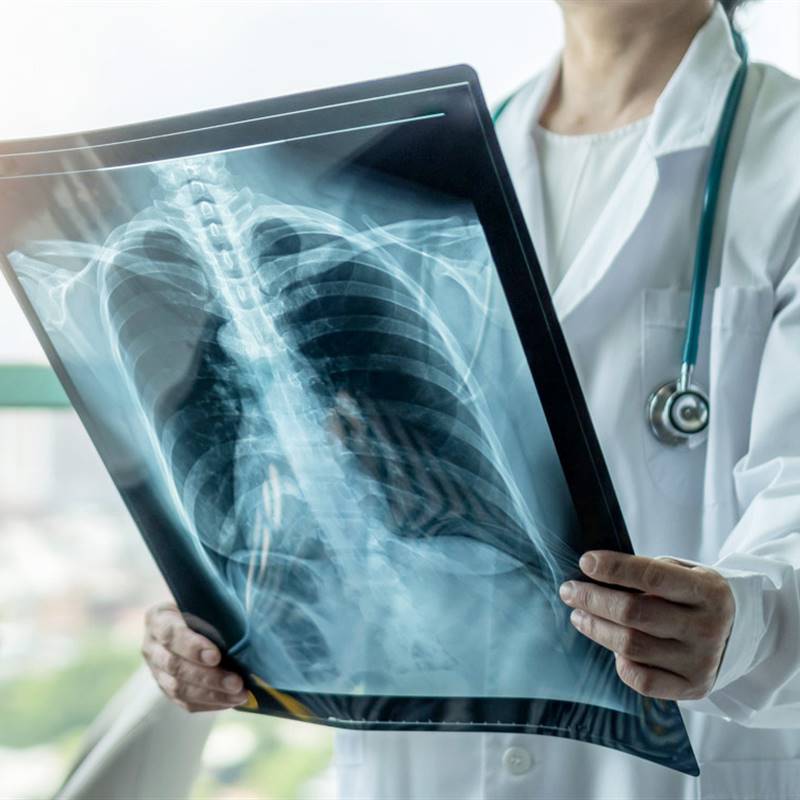 La tuberculosis se asocia a más riesgo de muerte porque acelera el envejecimiento de las células
