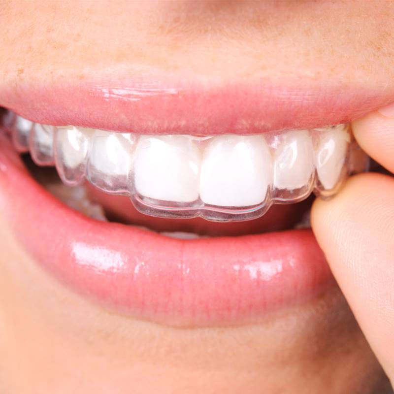 La ortodoncia invisible, cómo funciona y todo lo que tienes que saber