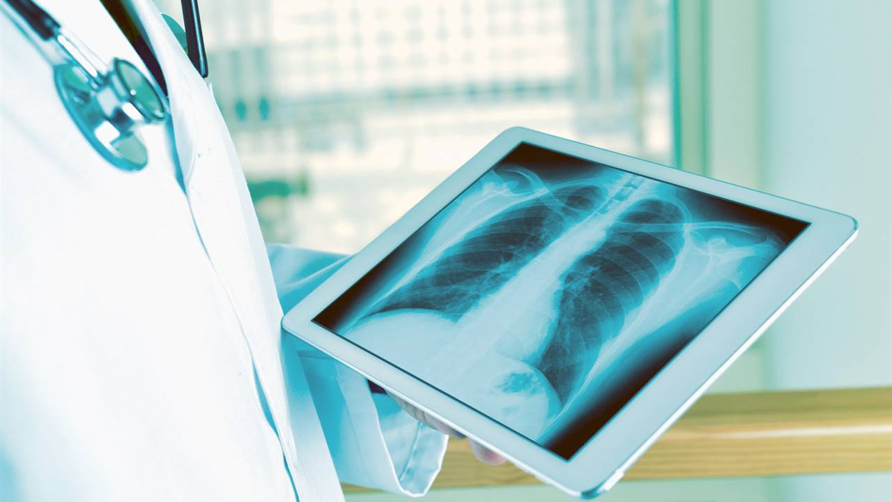 Tomografía: la prueba que habría que hacer de forma rutinaria para reducir el cáncer de pulmón