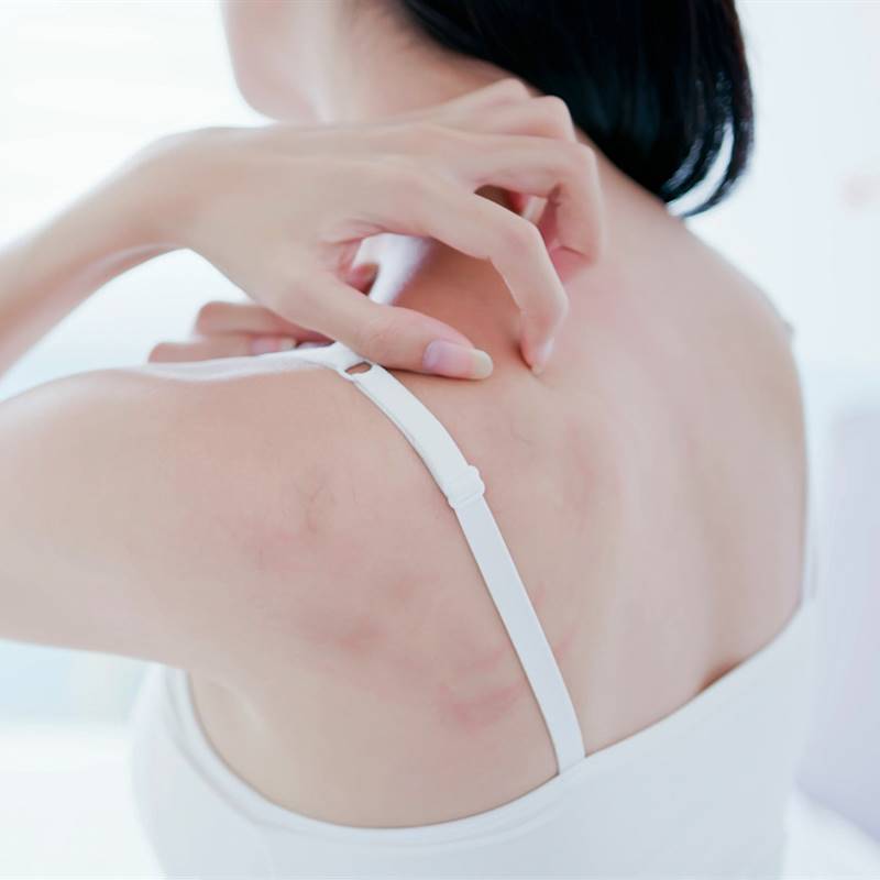 Si has sufrido un herpes puede aumentar tu riesgo de ictus
