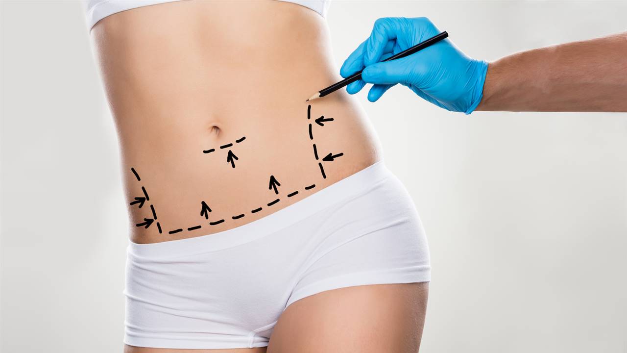 Abdominoplastia: cómo se hace la cirugía de reducción de abdomen