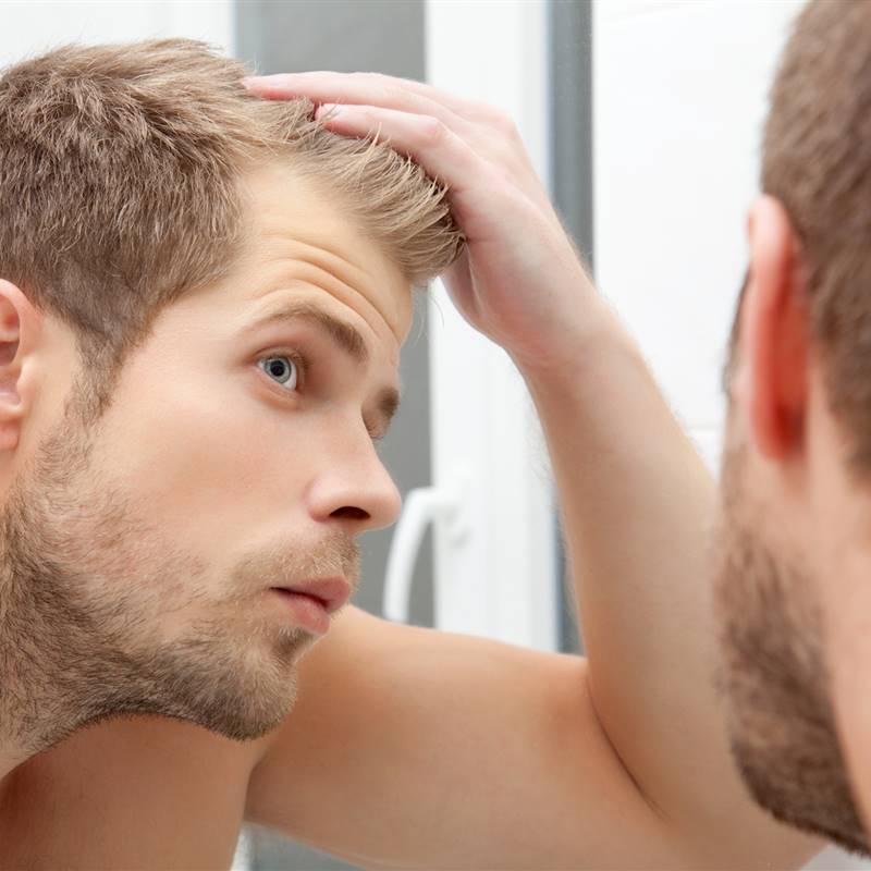 Injerto capilar: cómo se hace y cuáles son los efectos secundarios de un trasplante de pelo