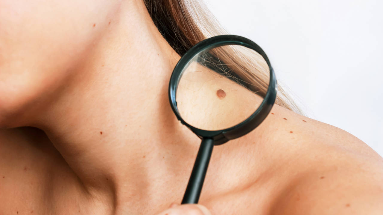 Prevenir el melanoma: estas son las señales para distinguir una peca buena de una mala