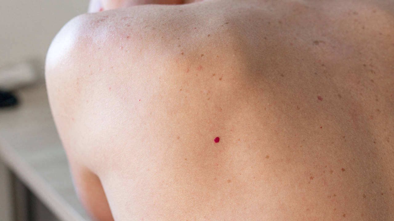 Petequias: por qué salen puntitos rojos en la piel y cuándo deben preocuparte