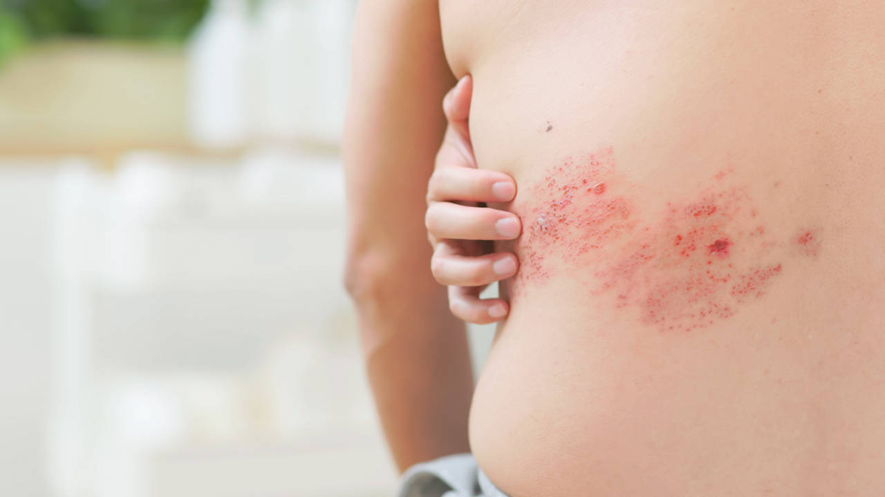 Se disparan los casos de herpes zóster entre los menores de 50 años ¿Por qué pasa?