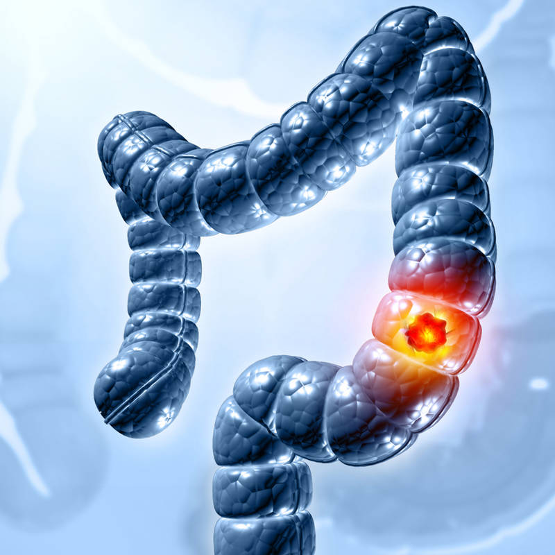 Cancer colon