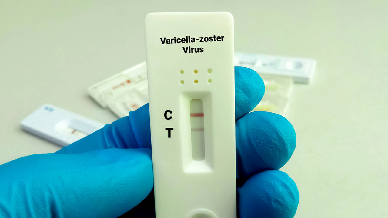 Encuentran la proteína responsable de la propagación del virus del herpes zóster