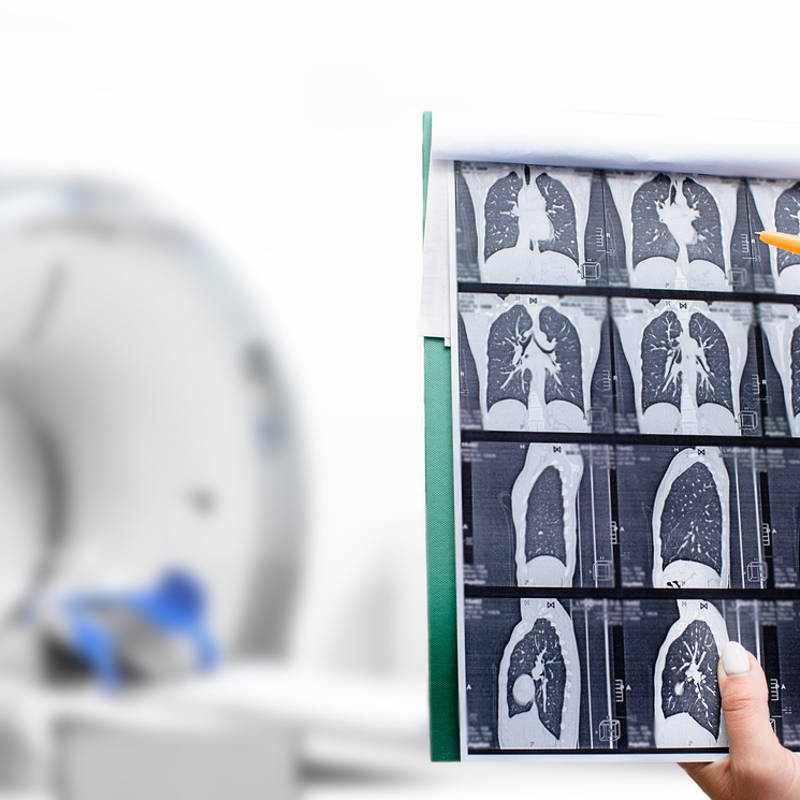 Tomografía: la prueba rutinaria que habría que hacer para detectar antes el cáncer de pulmón