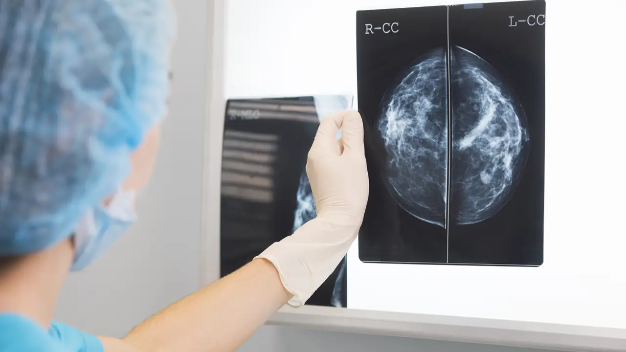 Una nueva terapia mejora el pronóstico del cáncer de mama más común