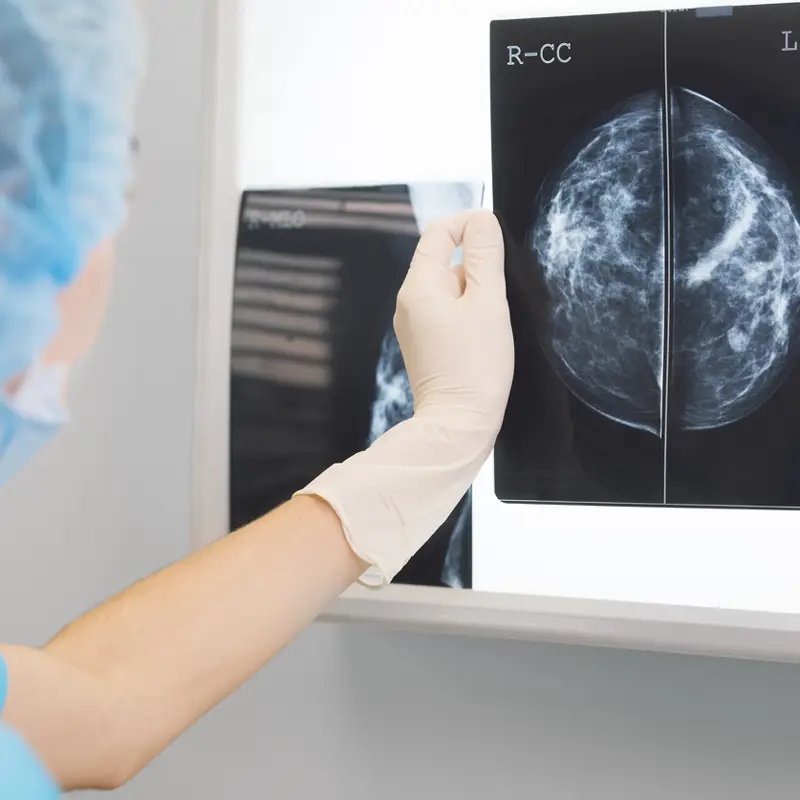 Una nueva terapia mejora el pronóstico del cáncer de mama más común