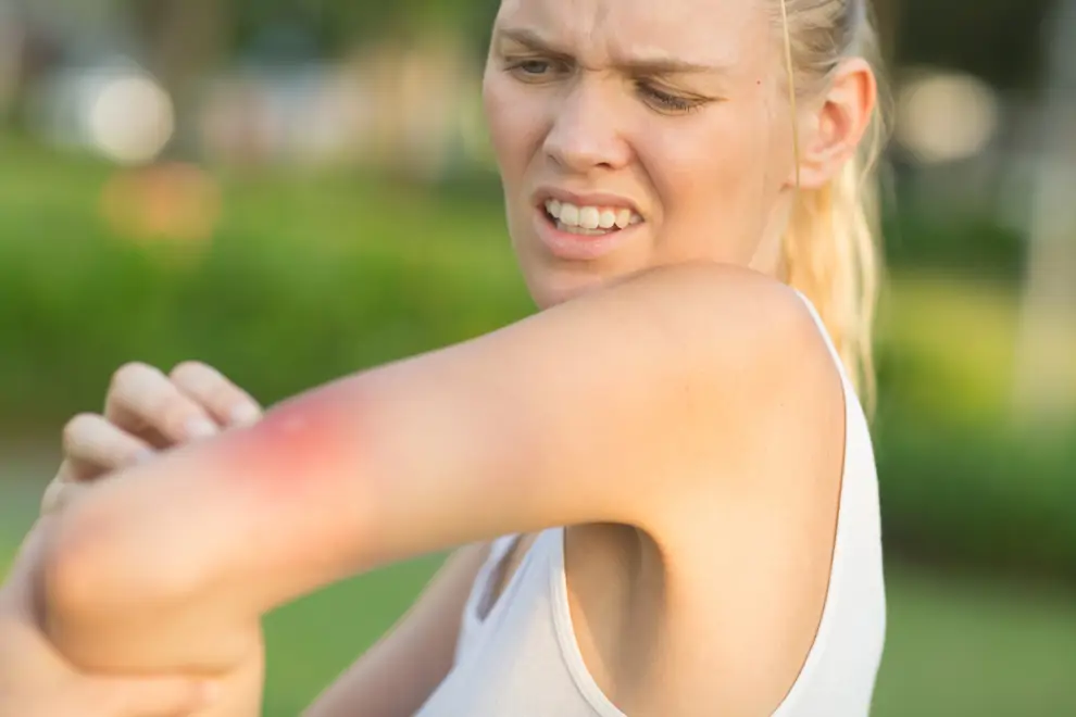 Mujer se rasca una picadura