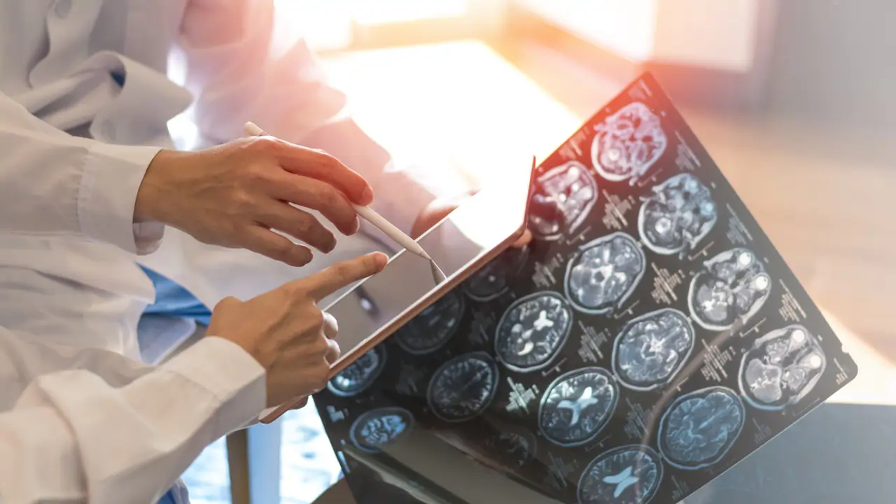 Los neurólogos recuerdan que cada cinco minutos se diagnostica un nuevo caso de esclerosis múltiple: “La detección precoz es fundamental”