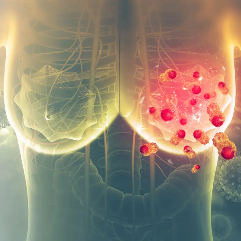 Un nuevo medicamento reduce a la mitad el riesgo de que el cáncer de mama continúe avanzando