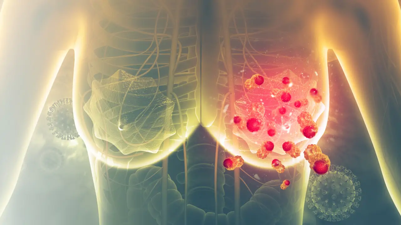 Un nuevo medicamento reduce a la mitad el riesgo de que el cáncer de mama continúe avanzando