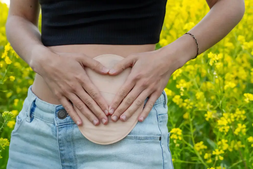 cáncer de colon