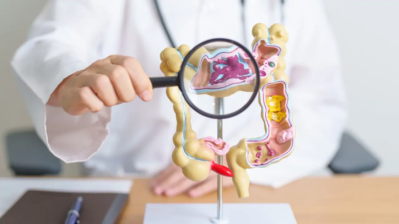 Enfermedad del colon, intestino grueso, cáncer colorrectal