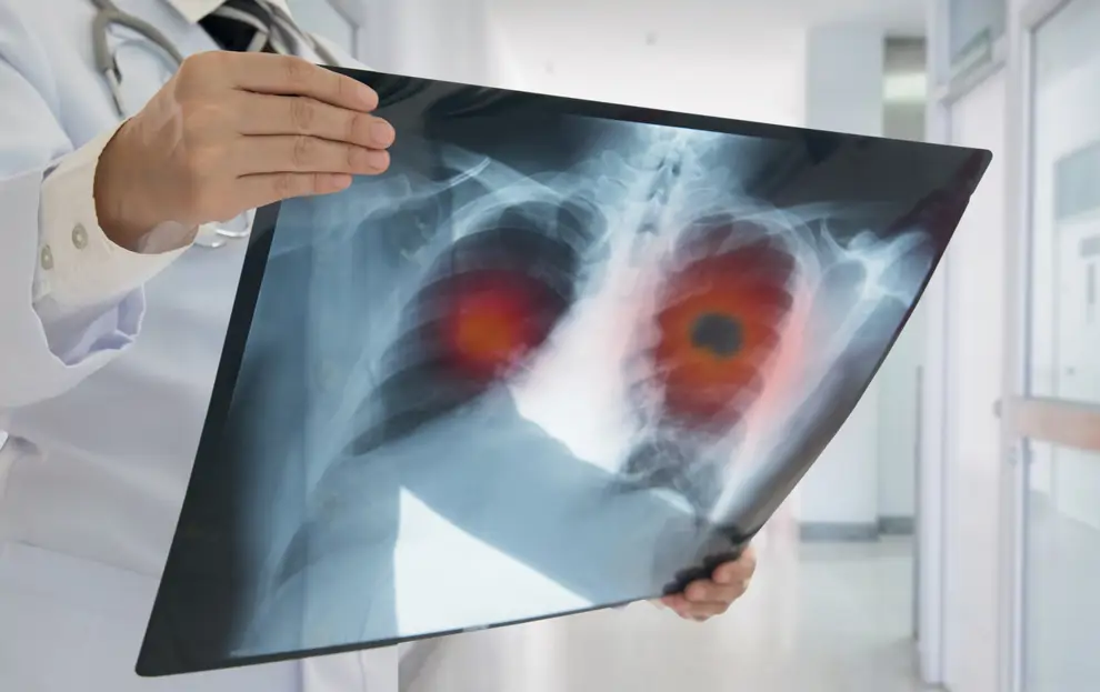 Radiografía cáncer de pulmón 